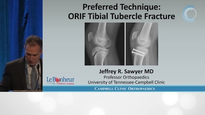 tibial tubercle