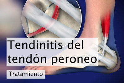 Tendinitis Archivos