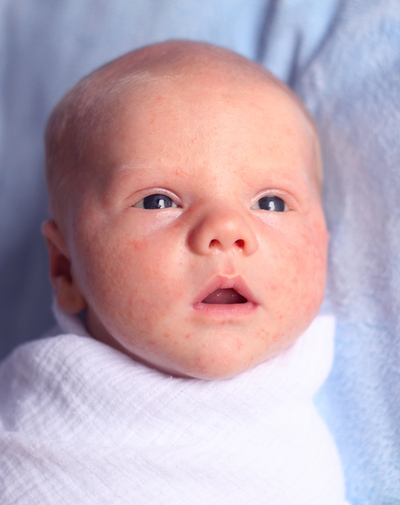 Как выглядит акне у детей What Does it Mean if My Newborn Has Acne? - HSC MediaSpace
