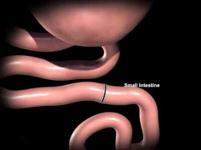 Rex Bariatrics: Gastric Bypass Surgery Explained - BYU-Idaho