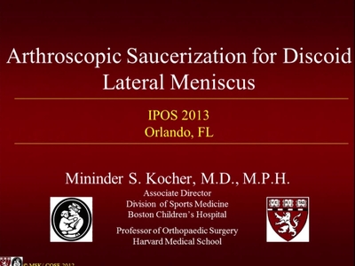 Arthroscopic Saucerization for Discoid Lateral Meniscus - POSNAcademy